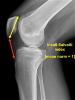 Pseudo-patella baja: giả xương bánh chè xuống thấp sau phẫu thuật thay khớp gối